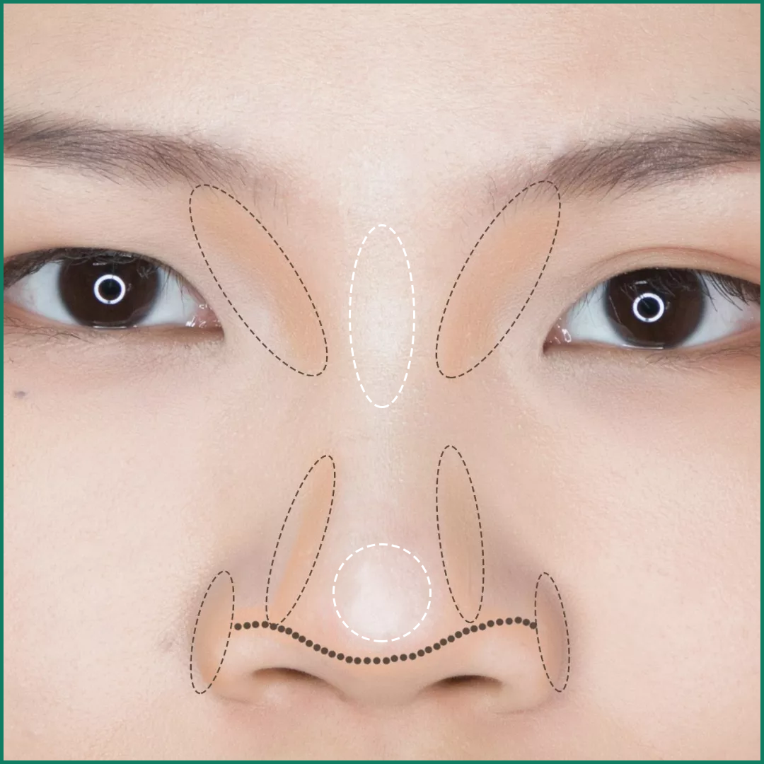 鼻翼缘缺失漏鼻孔修复案例，术后七天对比图分享—深圳李信锋隆鼻整形 - 知乎